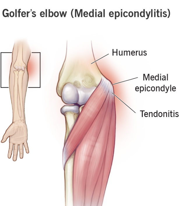 Diagram of a golfer's elbow displaying the humerus, medial epicondyle, and tendonitis area with labels.