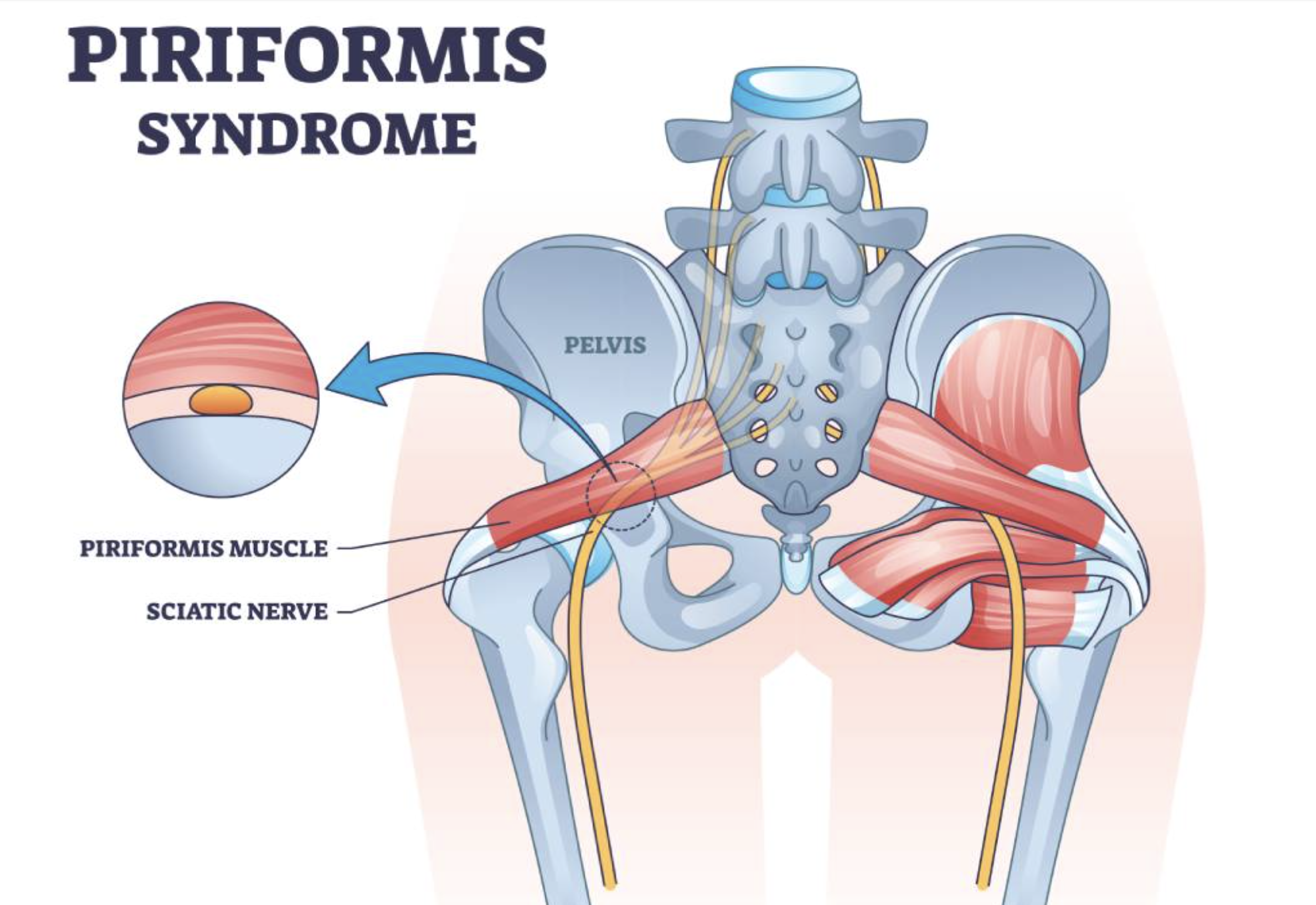 Diagram of the pelvis showing muscles and nerves related to Piriformis Syndrome, including the piriformis muscle and sciatic nerve.