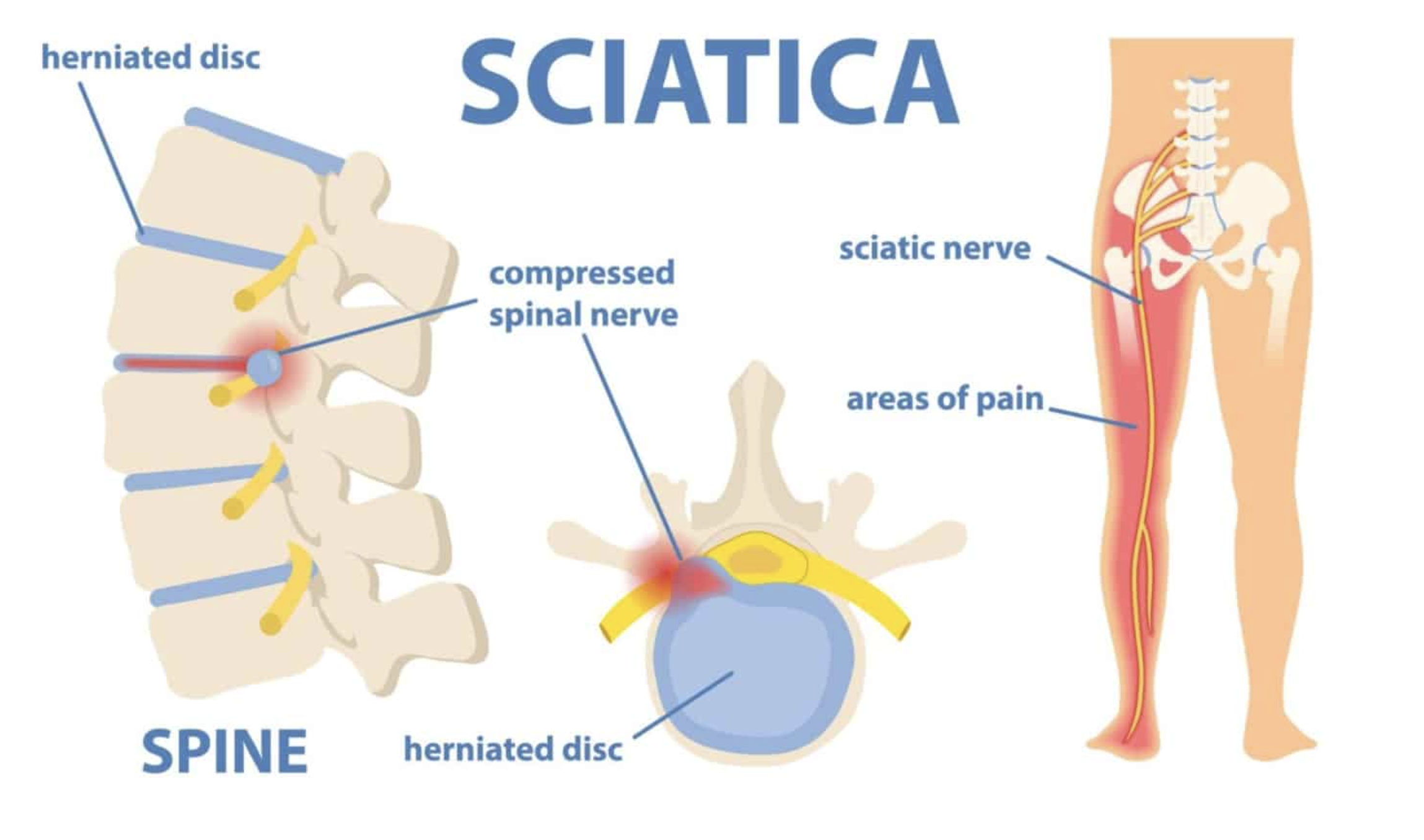 Diagram of sciatica with illustrations of herniated disc pressing on the spinal nerve, showing areas of pain along the sciatic nerve in the leg.