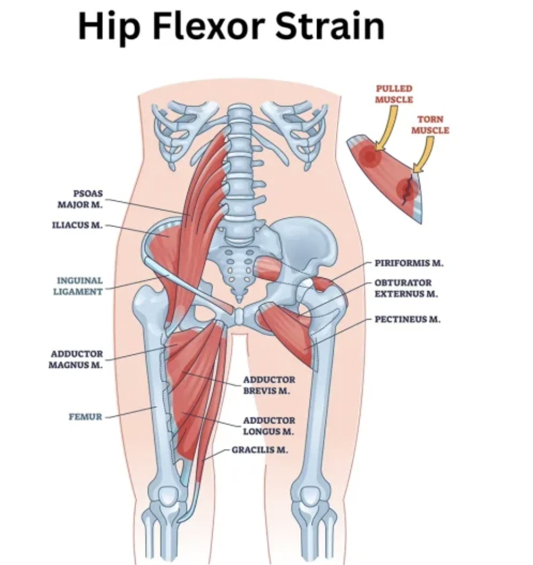 Diagram of hip flexor muscles and injuries, showing muscles such as psoas major, iliacus, piriformis, obturator externus, pectineus, and others. The image highlights a torn muscle with pulled muscle details.