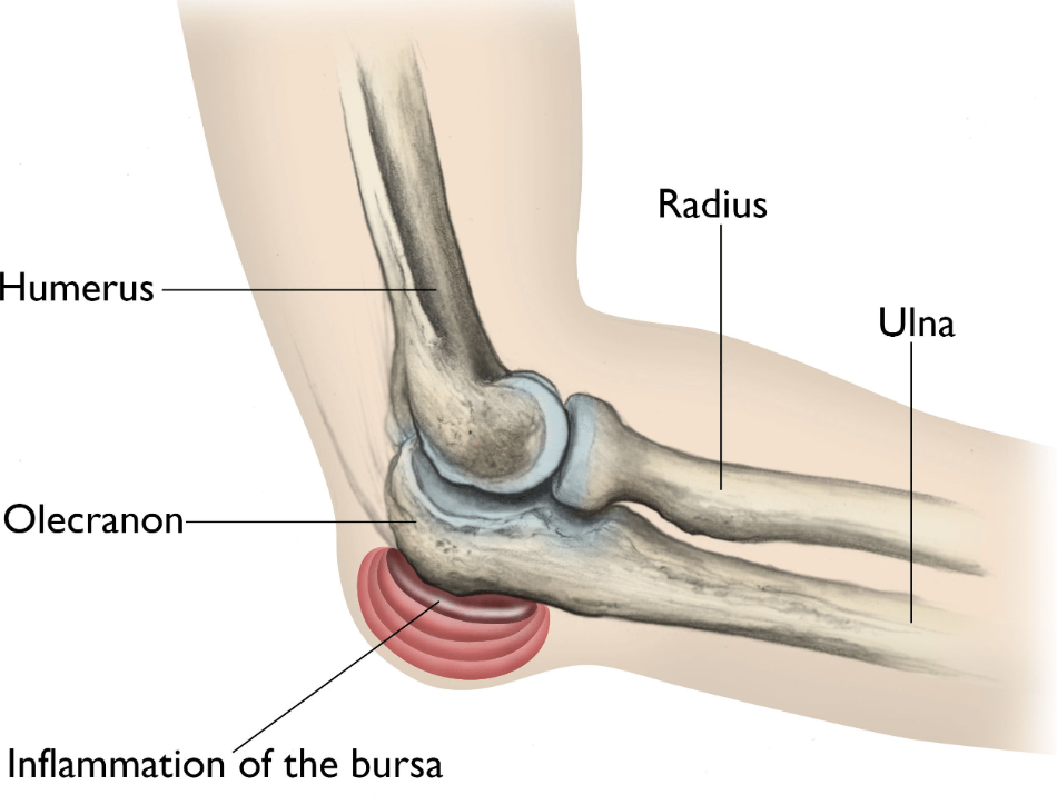 Diagram of a human elbow showing inflammation of the bursa, with labels for the humerus, olecranon, radius, and ulna.