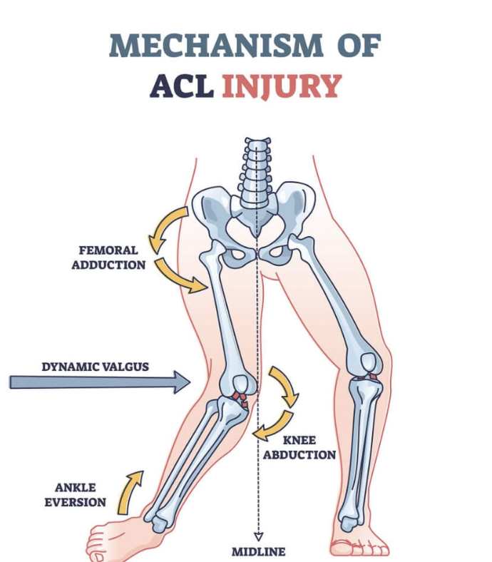 Diagram showing the mechanism of ACL injury with labels pointing to femoral adduction, dynamic valgus, knee abduction, ankle eversion, and midline