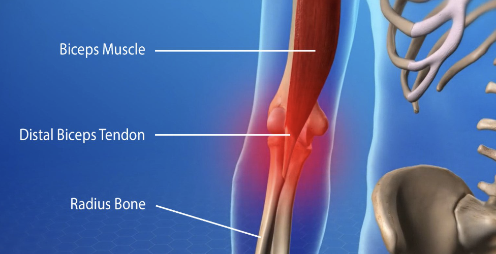 Diagram of a human arm showing the biceps muscle, distal biceps tendon, and radius bone with labels.