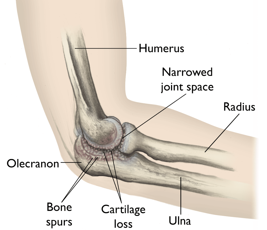Diagram of a human elbow showing bones, joint, and cartilage damage, labeled with humerus, ulna, radius, olecranon, bone spurs, cartilage loss, and narrow joint space.