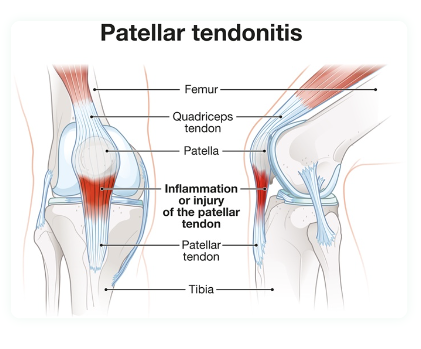 Diagram of knee with inflammation indicating patellar tendinitis, showing labels for femur, quadriceps tendon, patella, inflammation area, patellar tendon, and tibia.