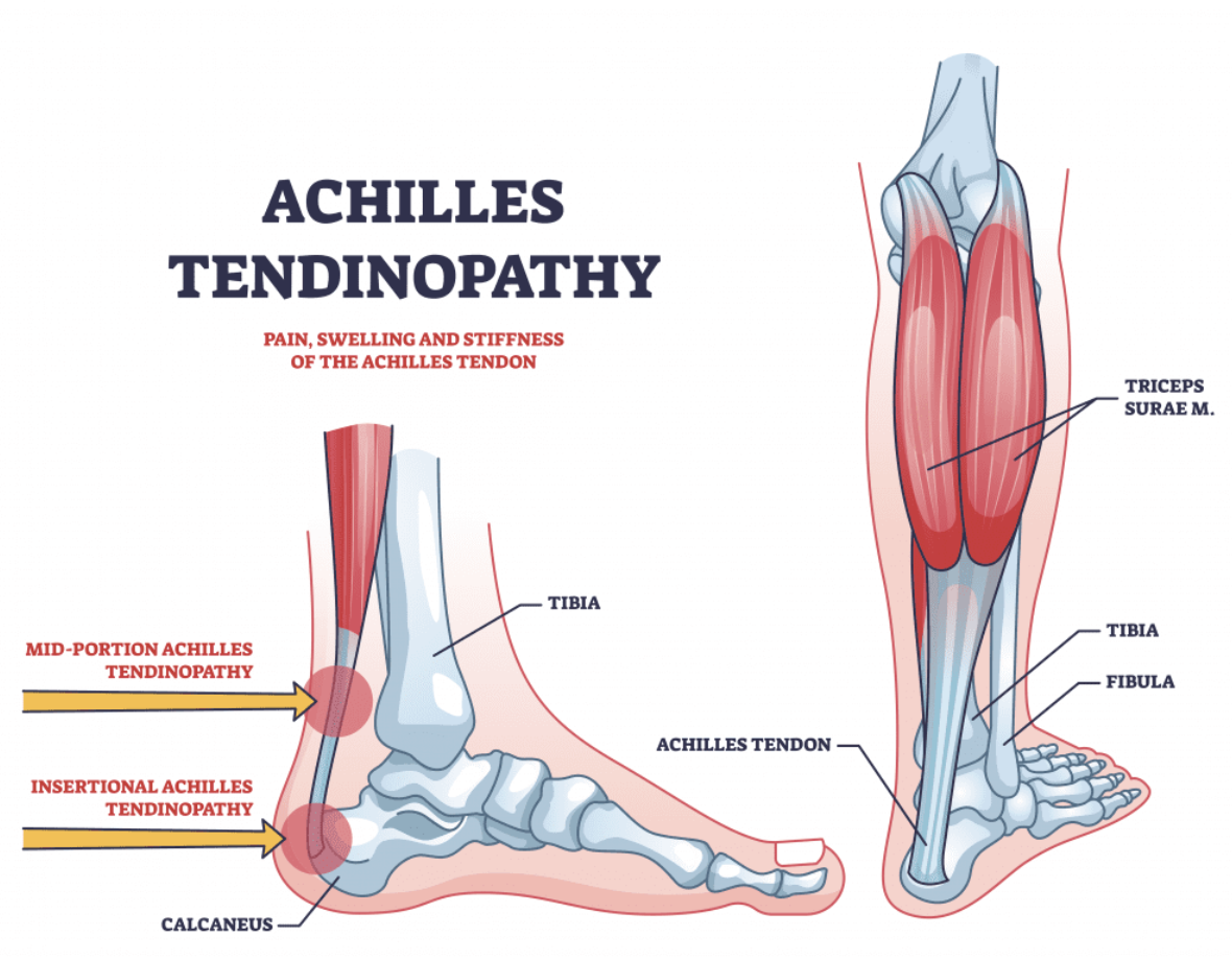 Diagram illustrating Achilles tendinopathy, showing pain, swelling, and stiffness in the Achilles tendon, with labels pointing to the Achilles tendon, tibia, fibula, and calf muscles.