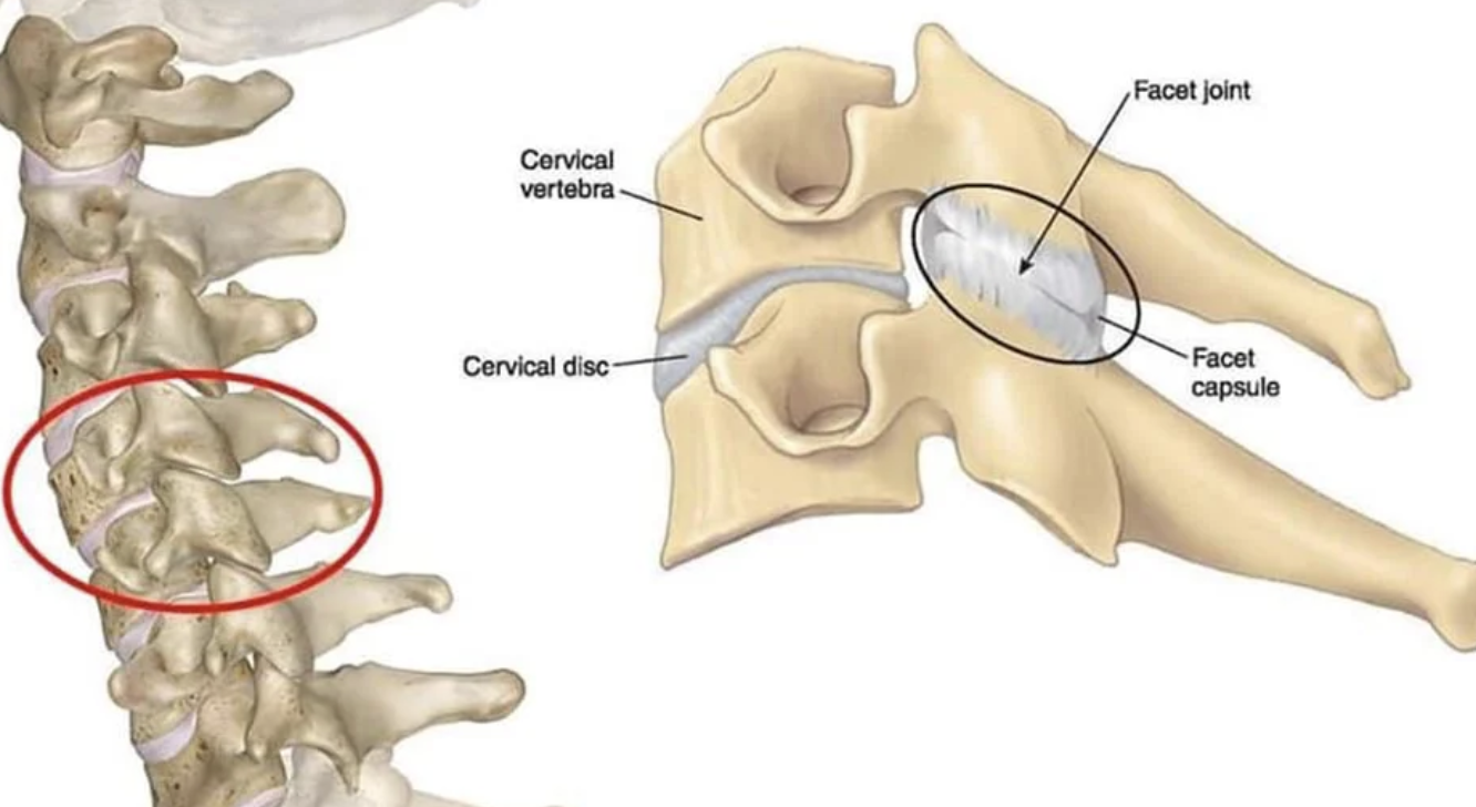 Diagram showing cervical vertebrae, cervical disc, and a detailed view of a cervical vertebra with the facet joint, facet capsule, and cervical disc labeled.