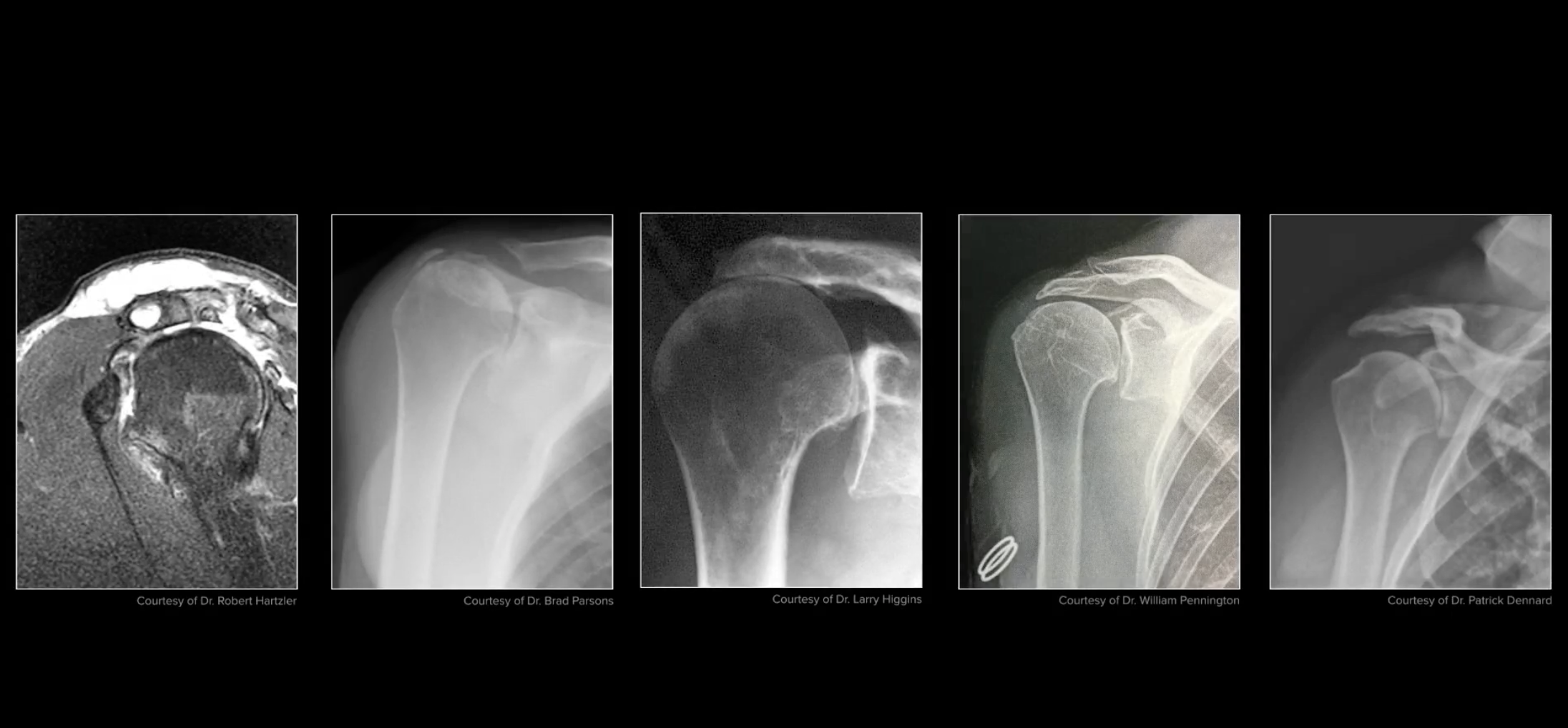 Cuff Tear Arthropathy — Jonathan Koscso, MD