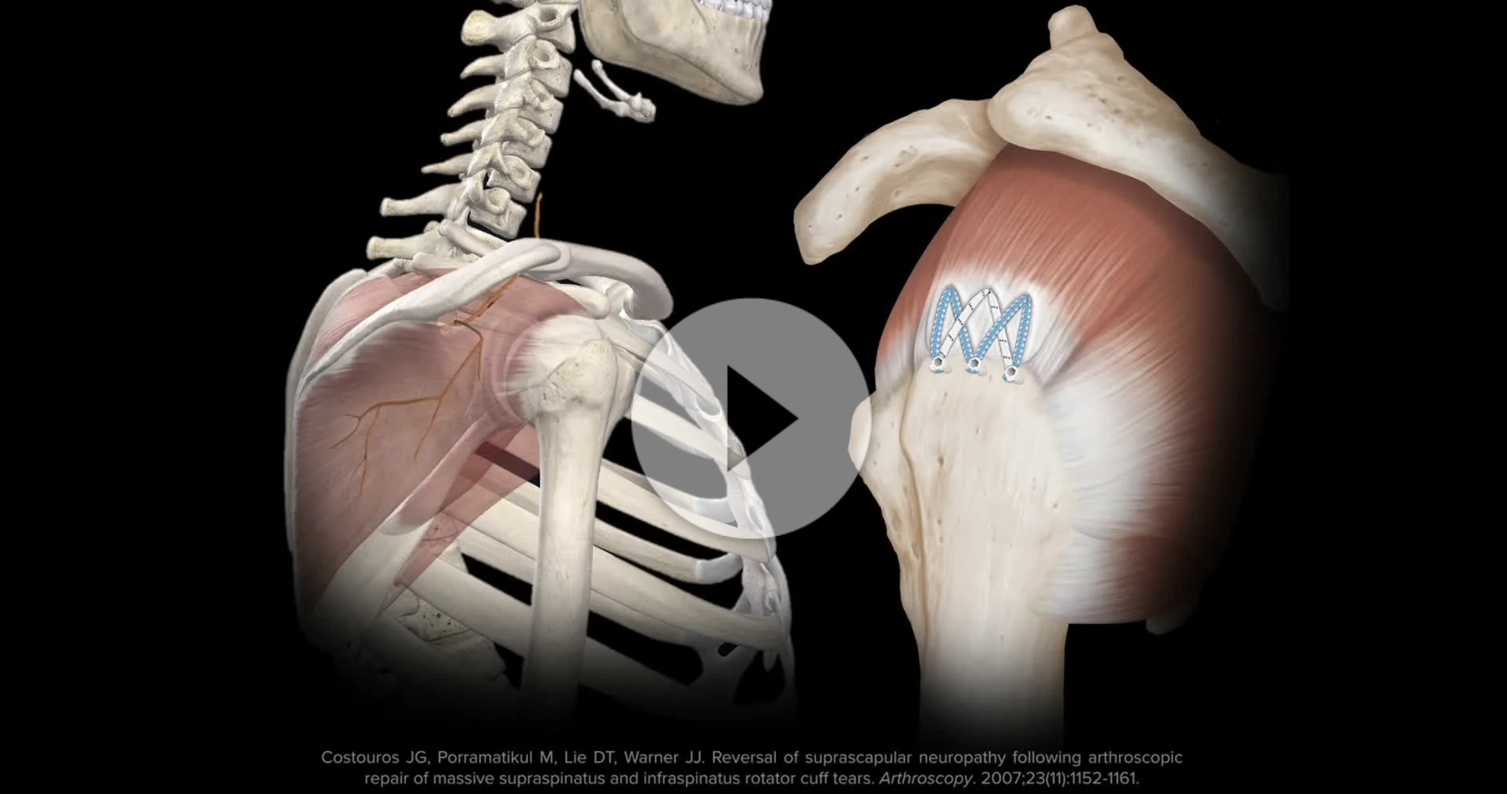 Rotator Cuff Tear — Jonathan Koscso, MD