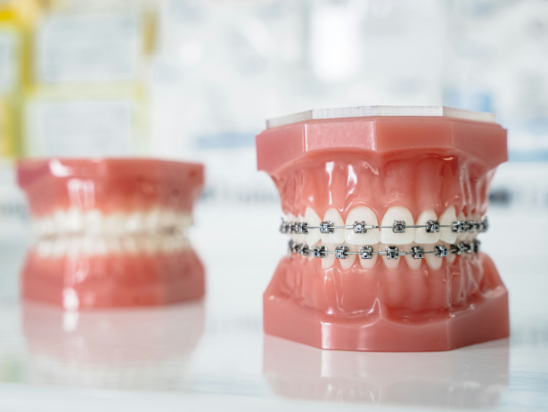 Power Chains on Braces: How They Accelerate Your Smile Transformation
