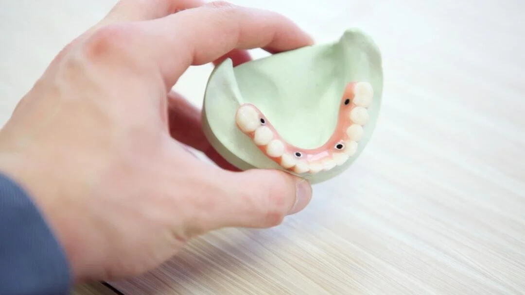Why Dental Implants are Worth the Investment