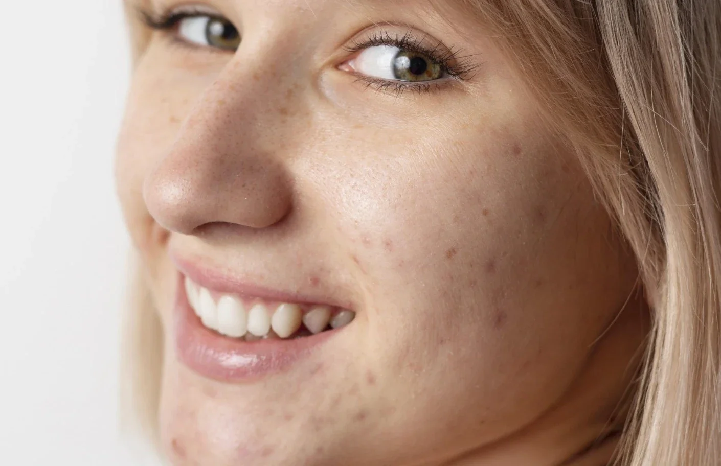 What Adults Should Know About Treating Acne Scars