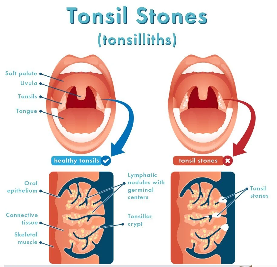 tonsil stones (tonsilliths)