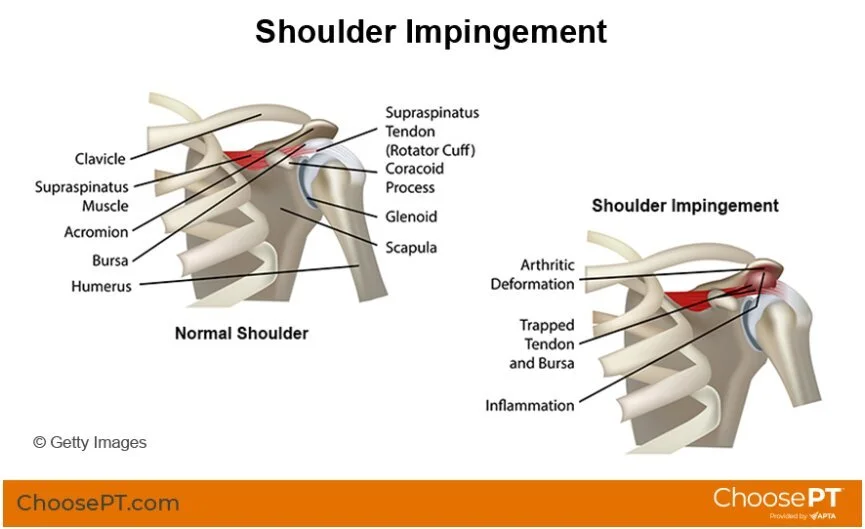 Shoulder impingement syndrome