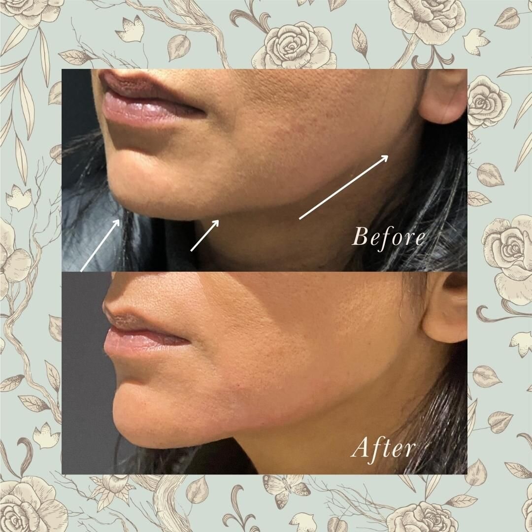 Another angle of our gorgeous lady who wanted her old, sharp jawline back. Small amounts of strategically placed filler helps contour and camouflage any heaviness in the lower face

For consultation &amp; to book👉🏼
020-7126 8305
info@drdenning.co.u