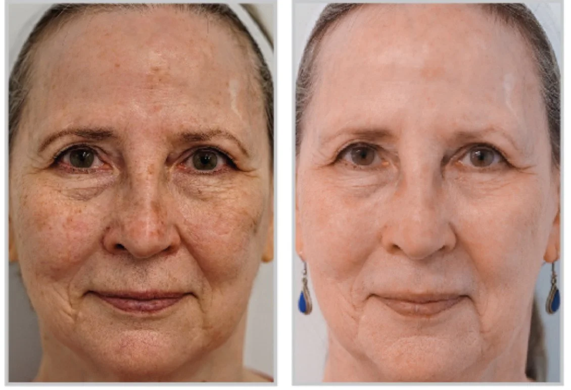 Skin Rejuvenation Laser - Get to Know BBL Heroic + Moxi: The Dream Team for Glowing Skin ✨