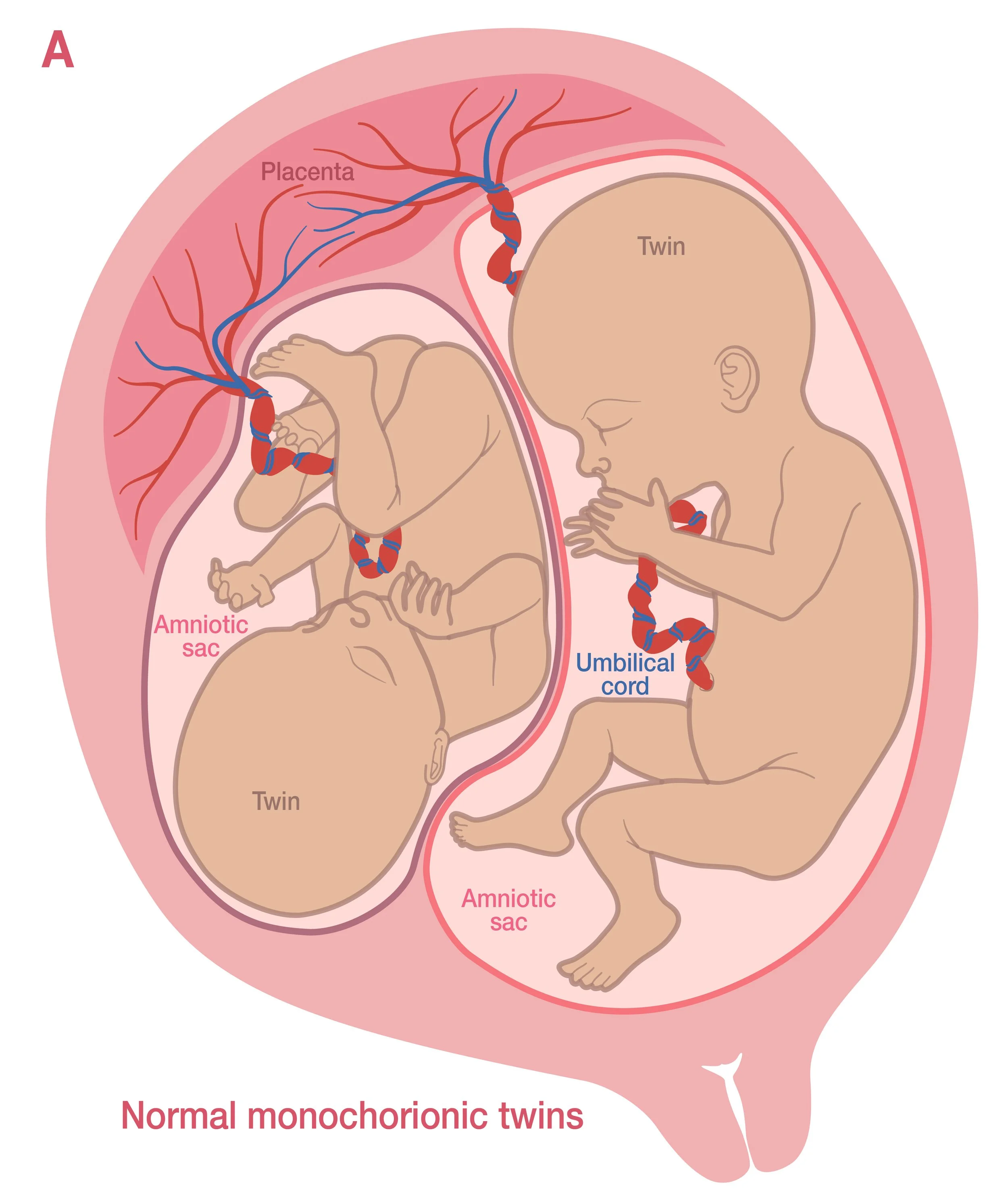 TTTS/TAPS — High Risk Pregnancy Information