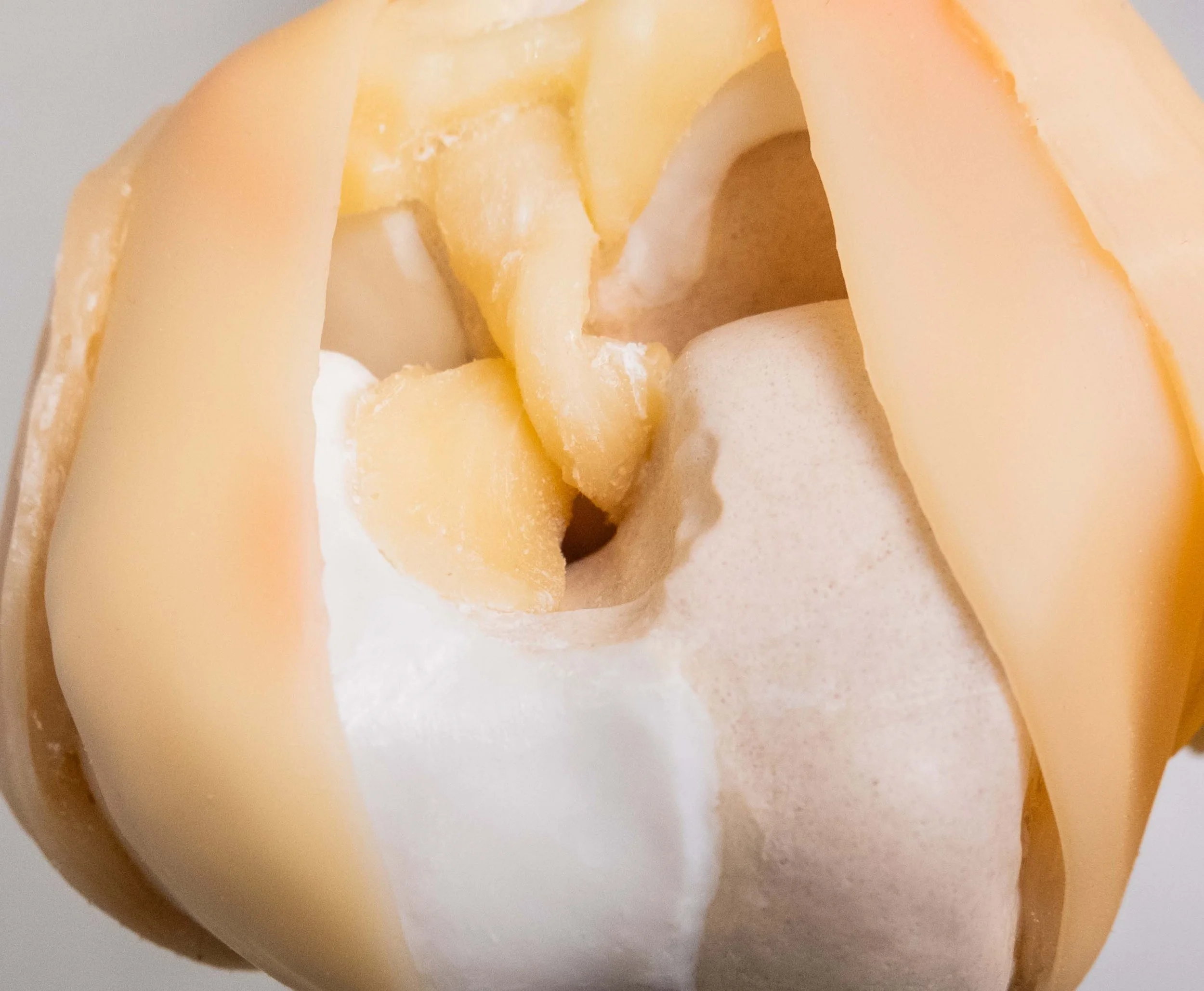 arthritic-valgus-varus-knee-right-closeup.jpg