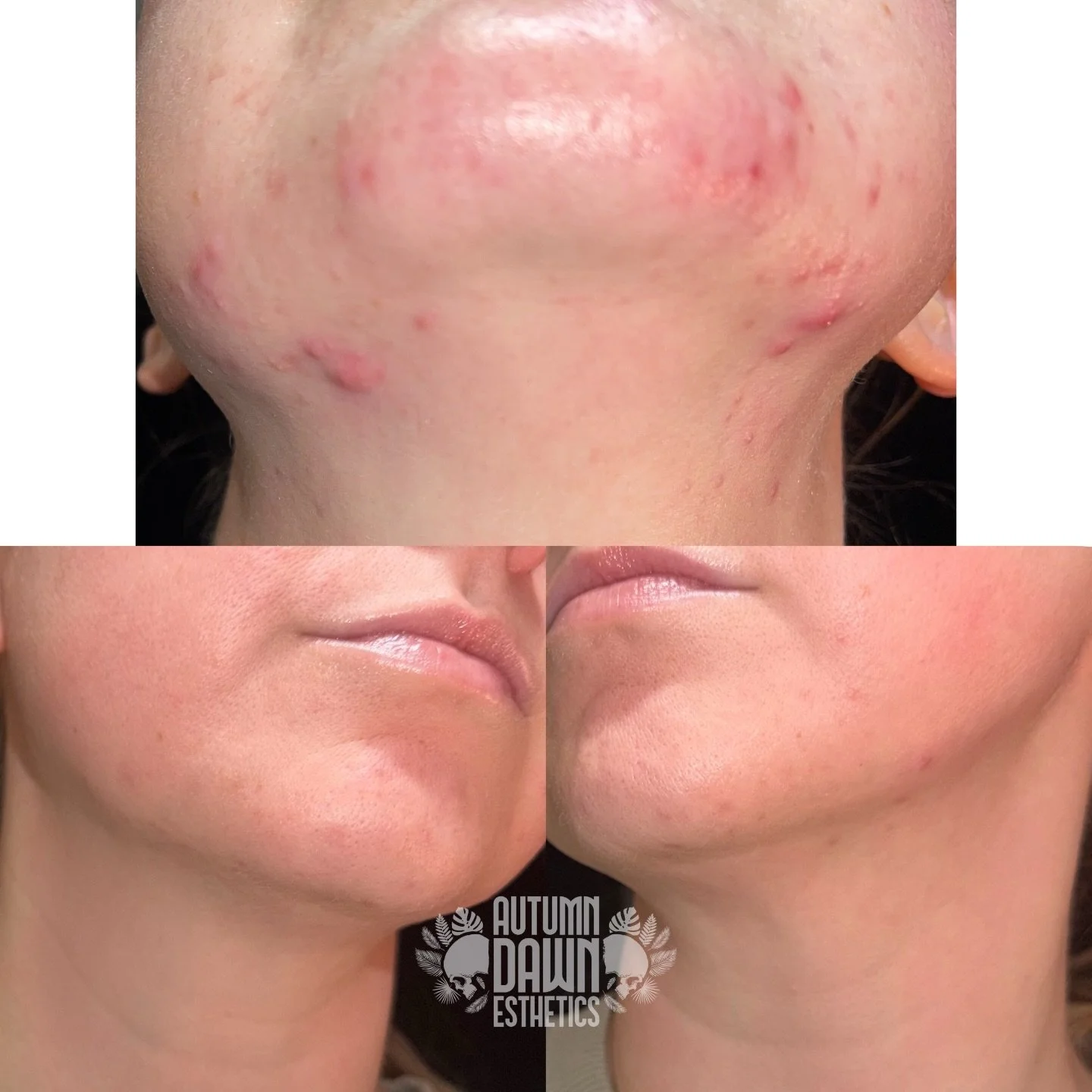 🙅&zwj;♀️ No in-person appointments
🙅&zwj;♀️ No prescriptions 
🙅&zwj;♀️ No more acne 

8 months of progress with a completely virtual client! If you can&rsquo;t make it to Ironton regularly or live outside the area, we can still treat breakouts 🤩
