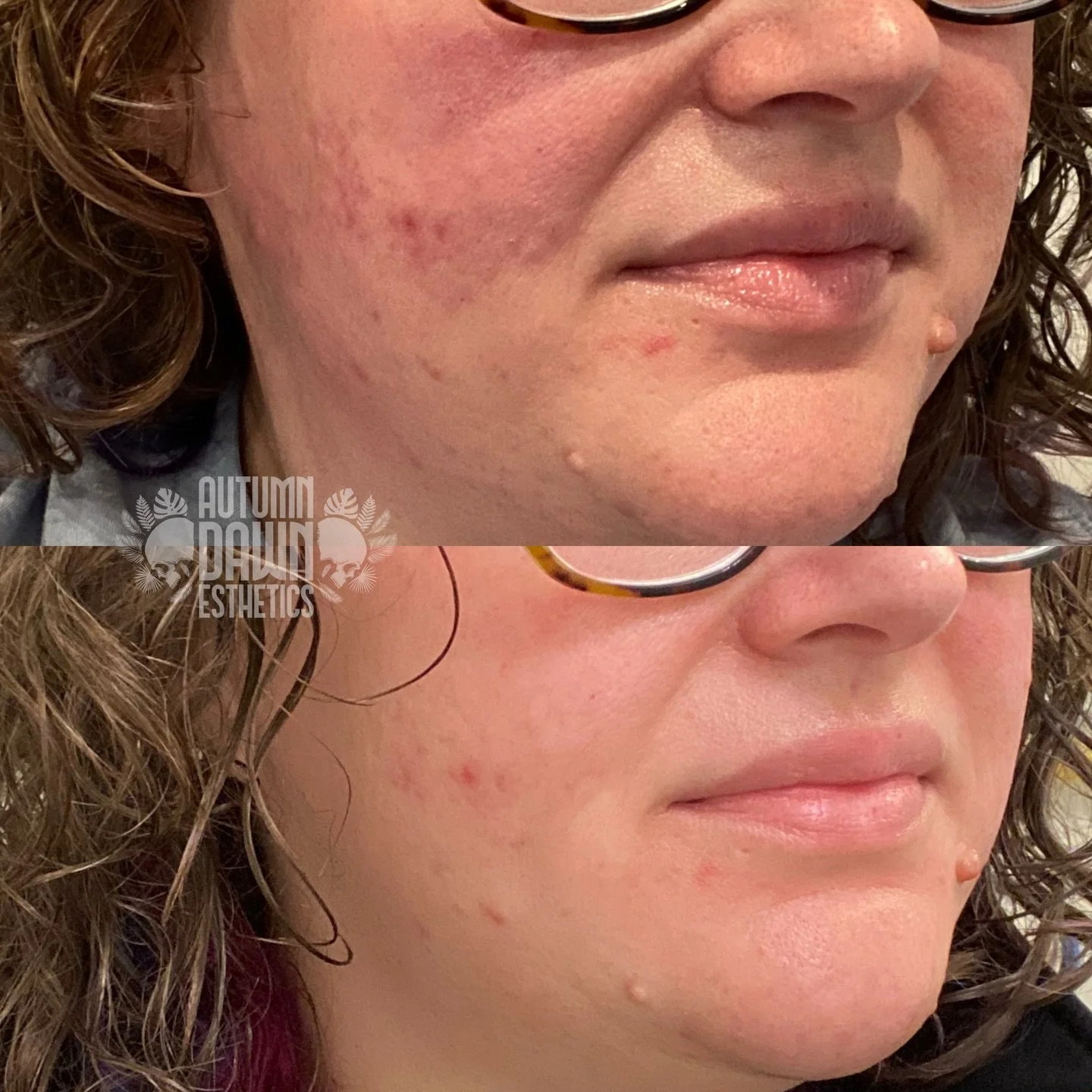 Shoutout to my clients that take progress photos 🤝

Dermaplane + @linderhealth Hero Peel = smooth, radiant skin 

In just 4 days her skin transformed and I can&rsquo;t get over these results! 😍

#skincare #chemicalpeel #linderhealth #brightening #s