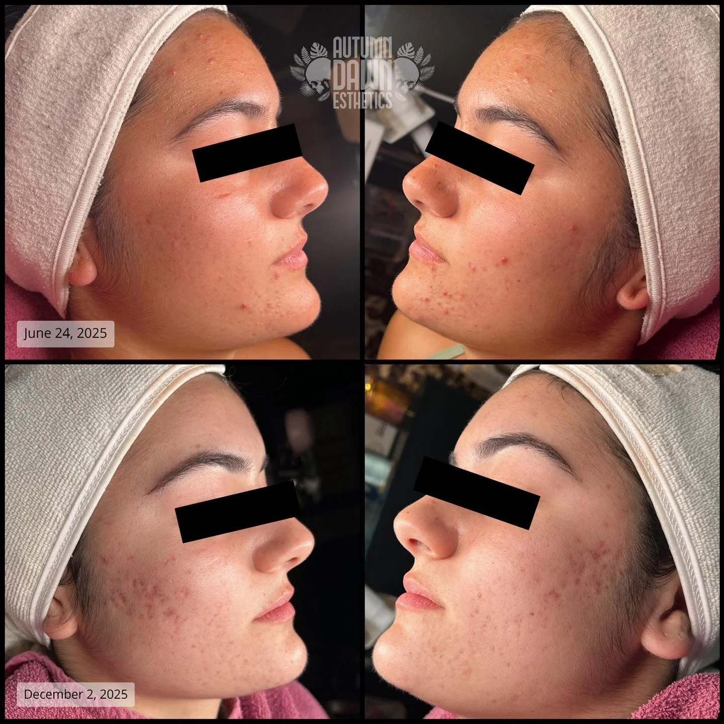 Strap in and let&rsquo;s go on an acne journey! 🚗 

Treating acne, in theory, is a linear process. There are certain reactions that will occur that don&rsquo;t always feel like progress, but I can almost always guarantee they are normal and are part