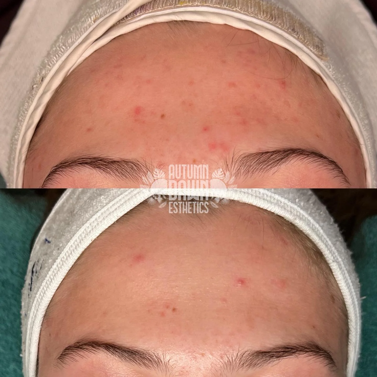 If you&rsquo;re constantly trying new acne products but nothing seems to work&hellip; you&rsquo;re probably overloading an already compromised barrier. A few weeks with gentle products can really do your skin some good. Next, we&rsquo;ll start target