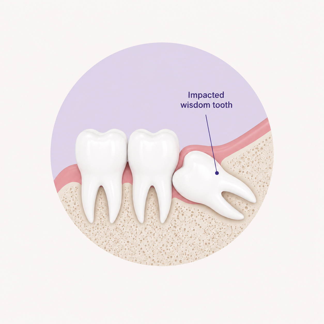 Do I Need To Remove My Wisdom Tooth?