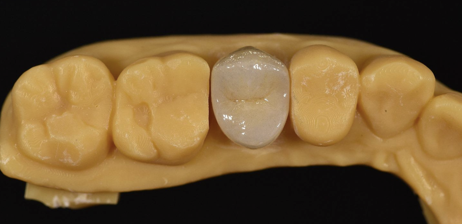 Close-up view of a dental model showing a tooth-colored dental crown fitting over a tooth, with adjacent teeth visible.