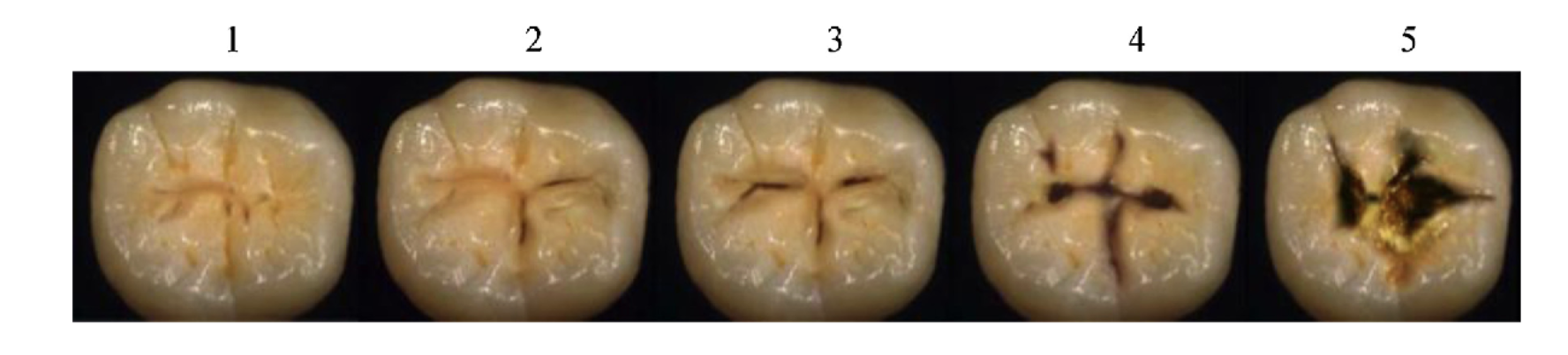 Close-up of five teeth showing stages of decay or damage from healthy to severely decayed, numbered 1 to 5.