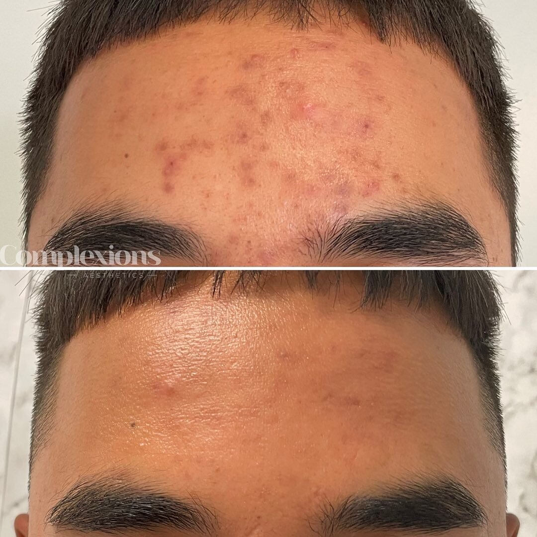 Acne scars who? 🙅&zwj;♂️

Cosmelan works to treat all types of hyperpigmentation - including post inflammatory hyperpigmentation (PIH) which darker skin tones with more melanin are more prone to

This picture is taken straight after phase 1 of Cosme