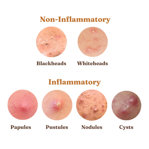 Acne 101: The Different Types of Acne — ARC WELLNESS