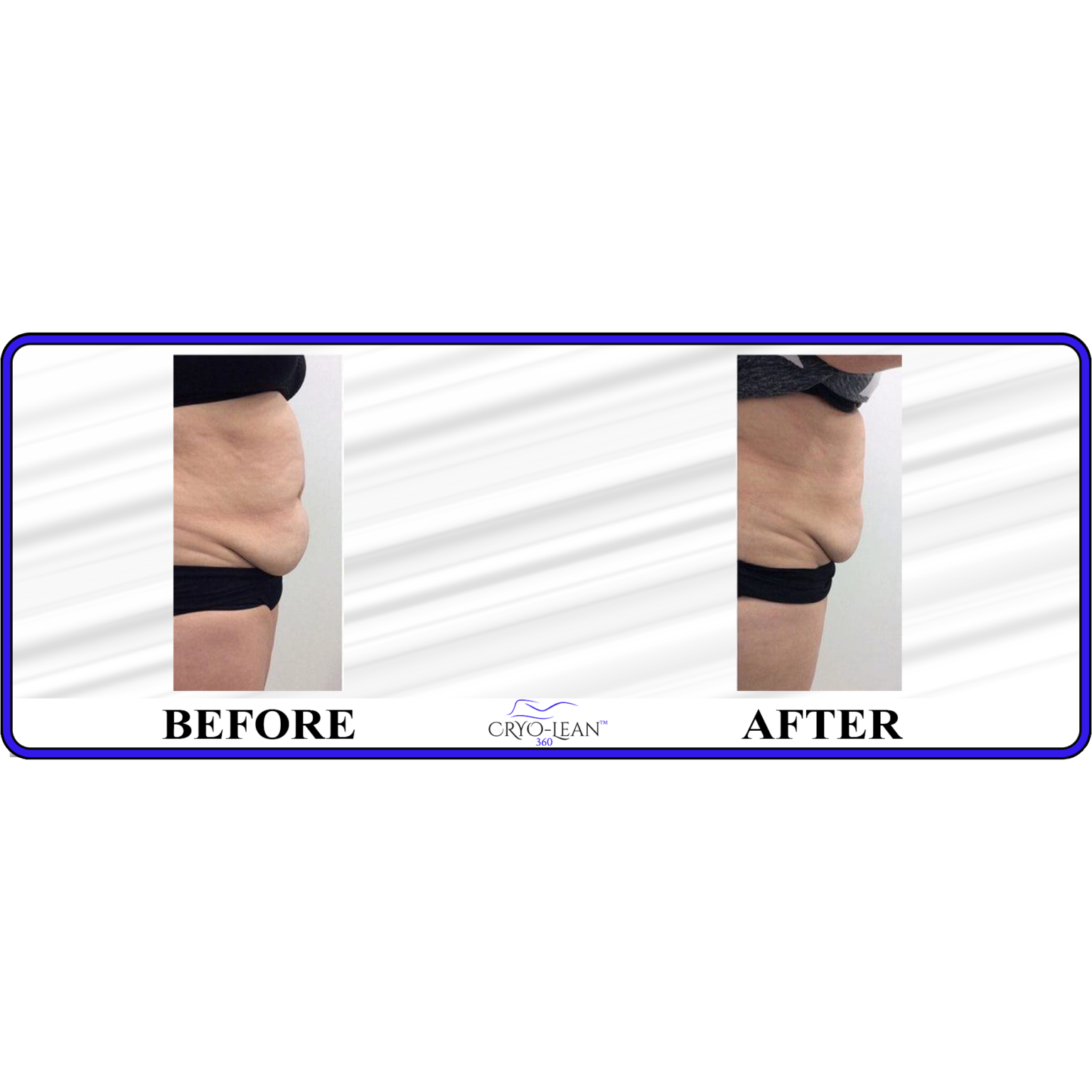 Before After Stomach Side.png