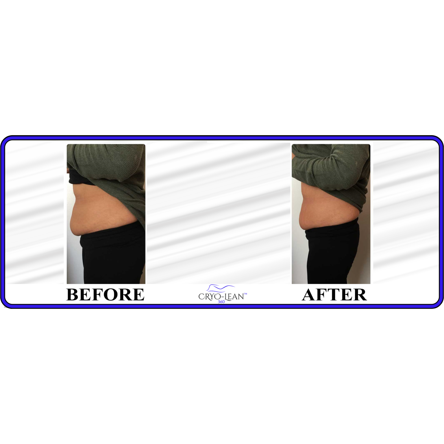 Before After Stomach left side.png
