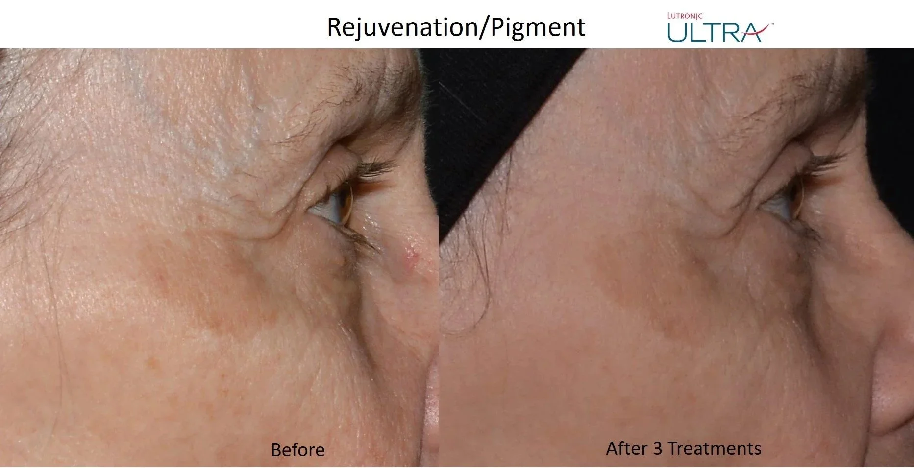 Ultra+Loverme+Rejuvenation+Pigment+2+close+up+profile.jpg