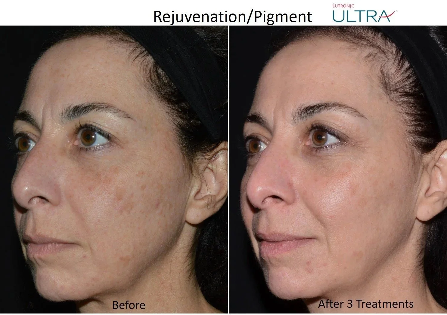 Ultra+Loverme+Rejuvenation+Pigment+4+Left.jpg