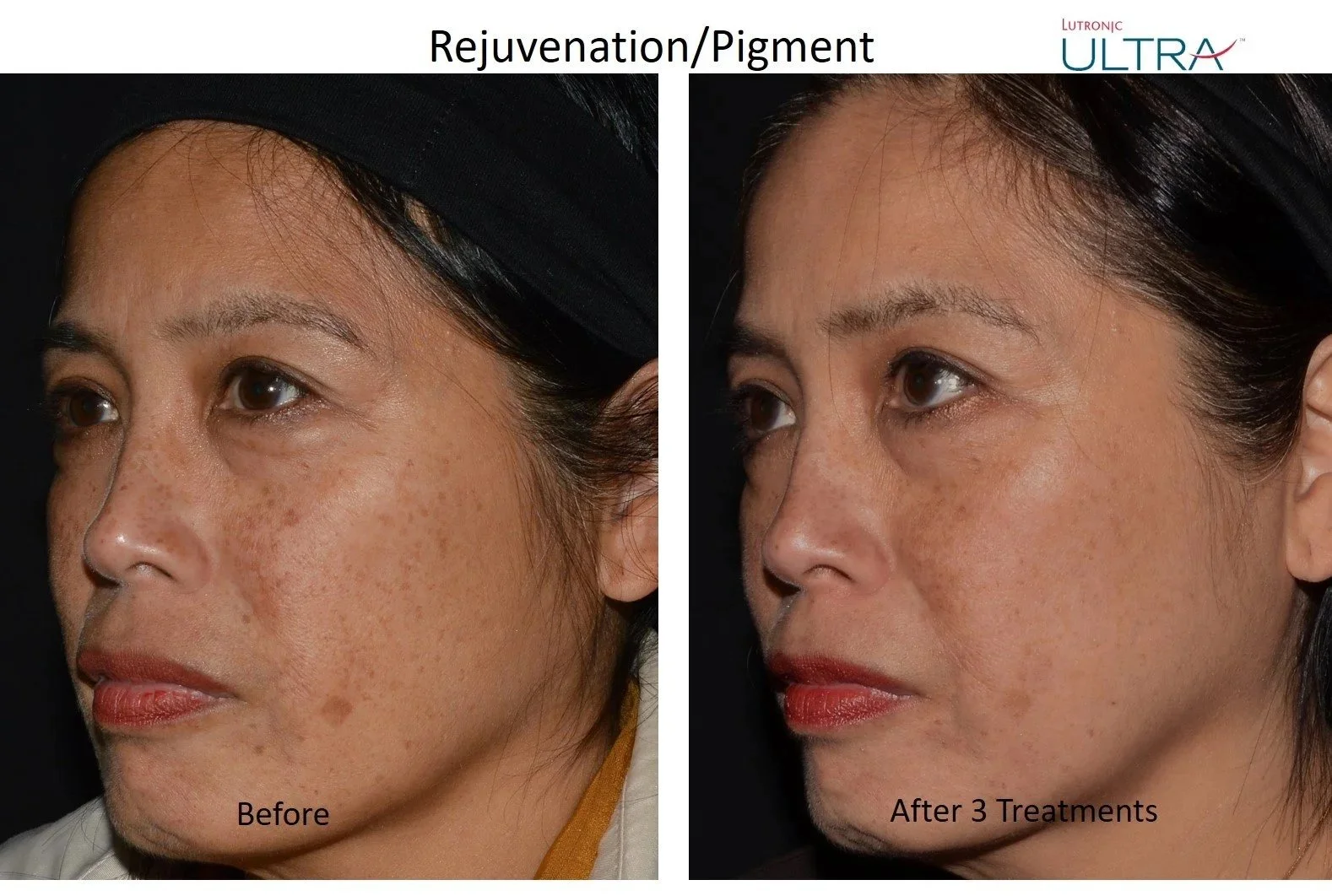 Ultra+Loverme+Rejuvenation+Pigment+6+Left.jpg