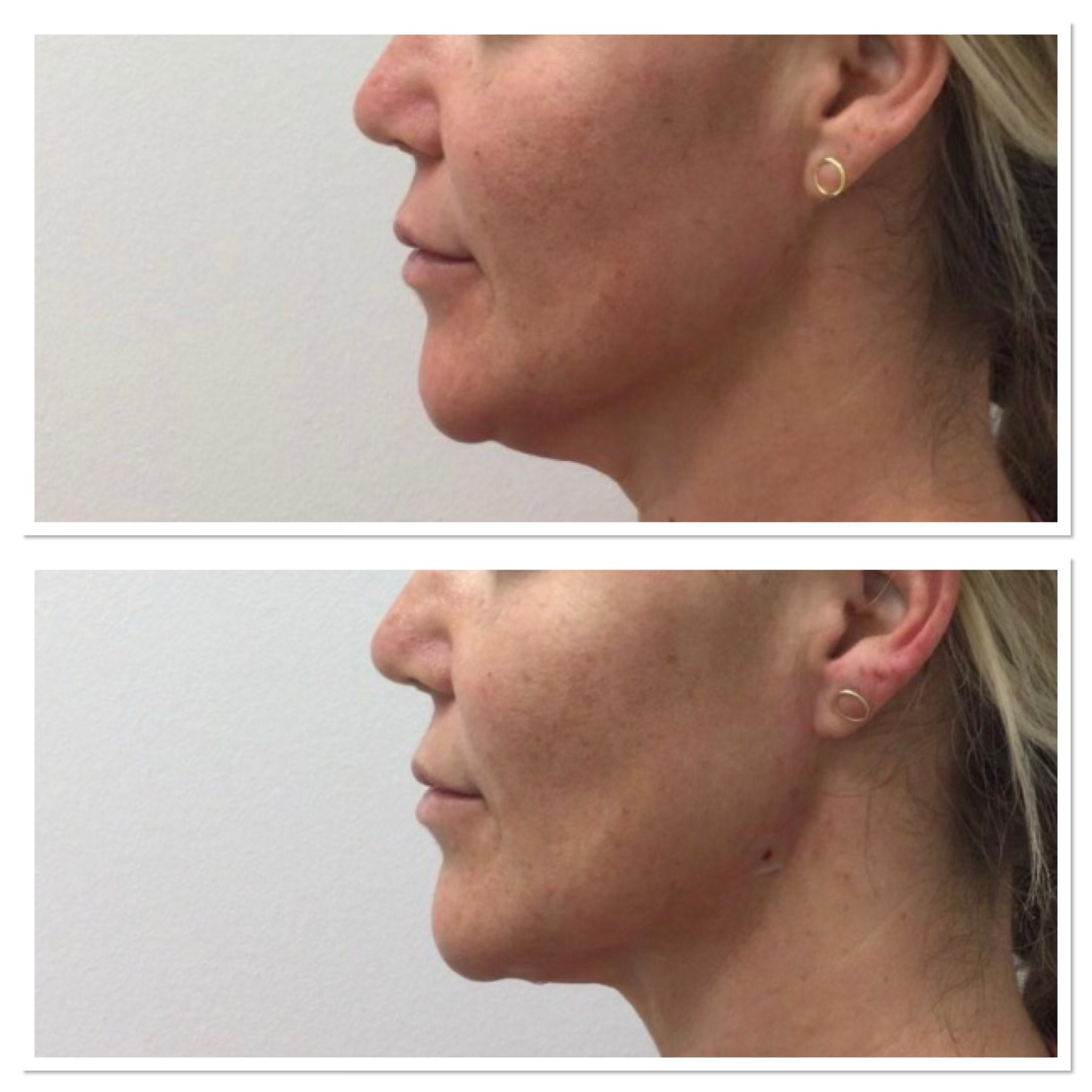 PDO Necklift