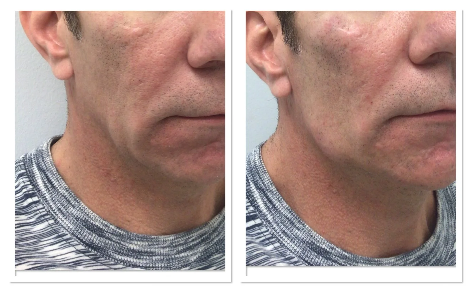Volux, Radiesse, Voluma