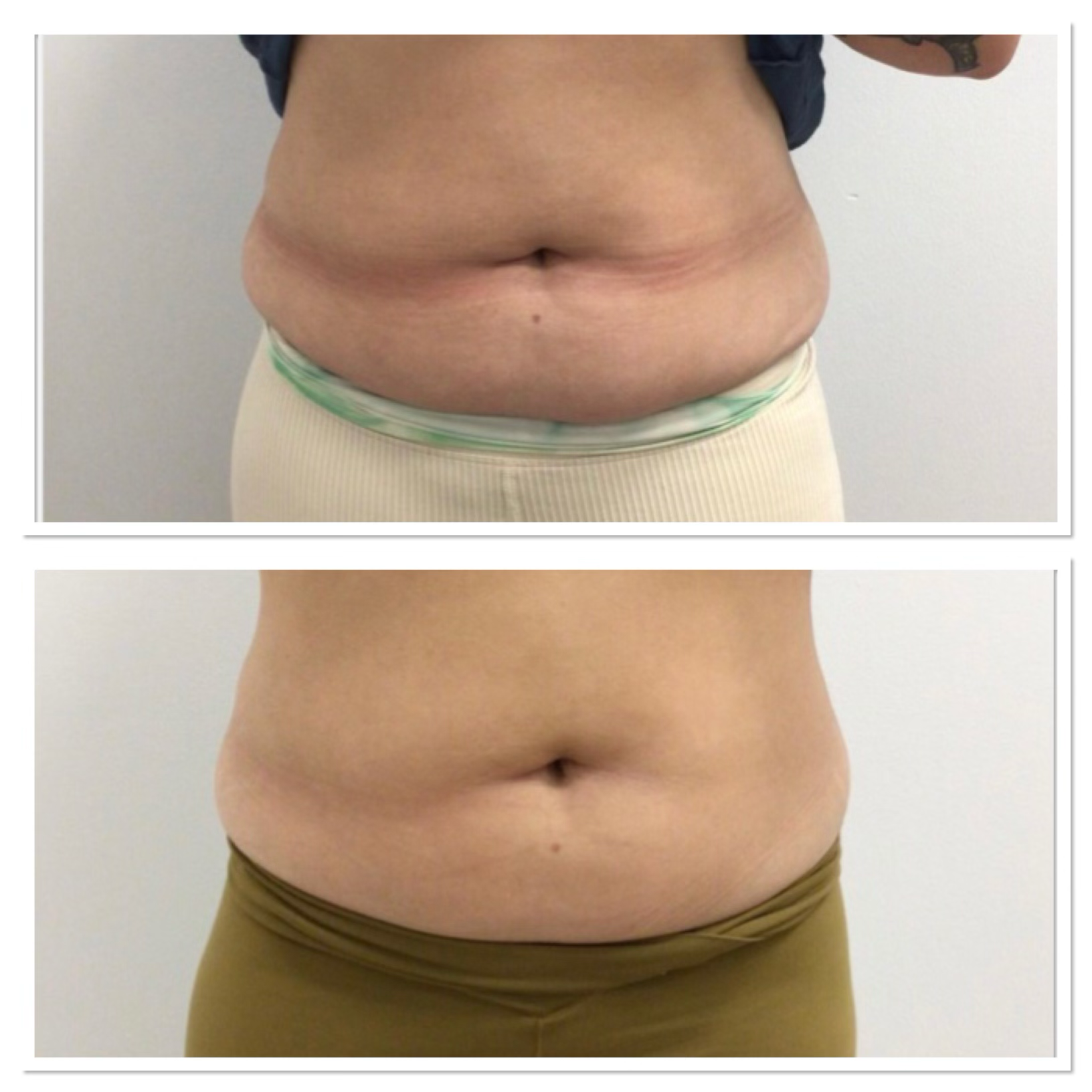 EMSCULPT NEO 4 Treatments - 75 Days After