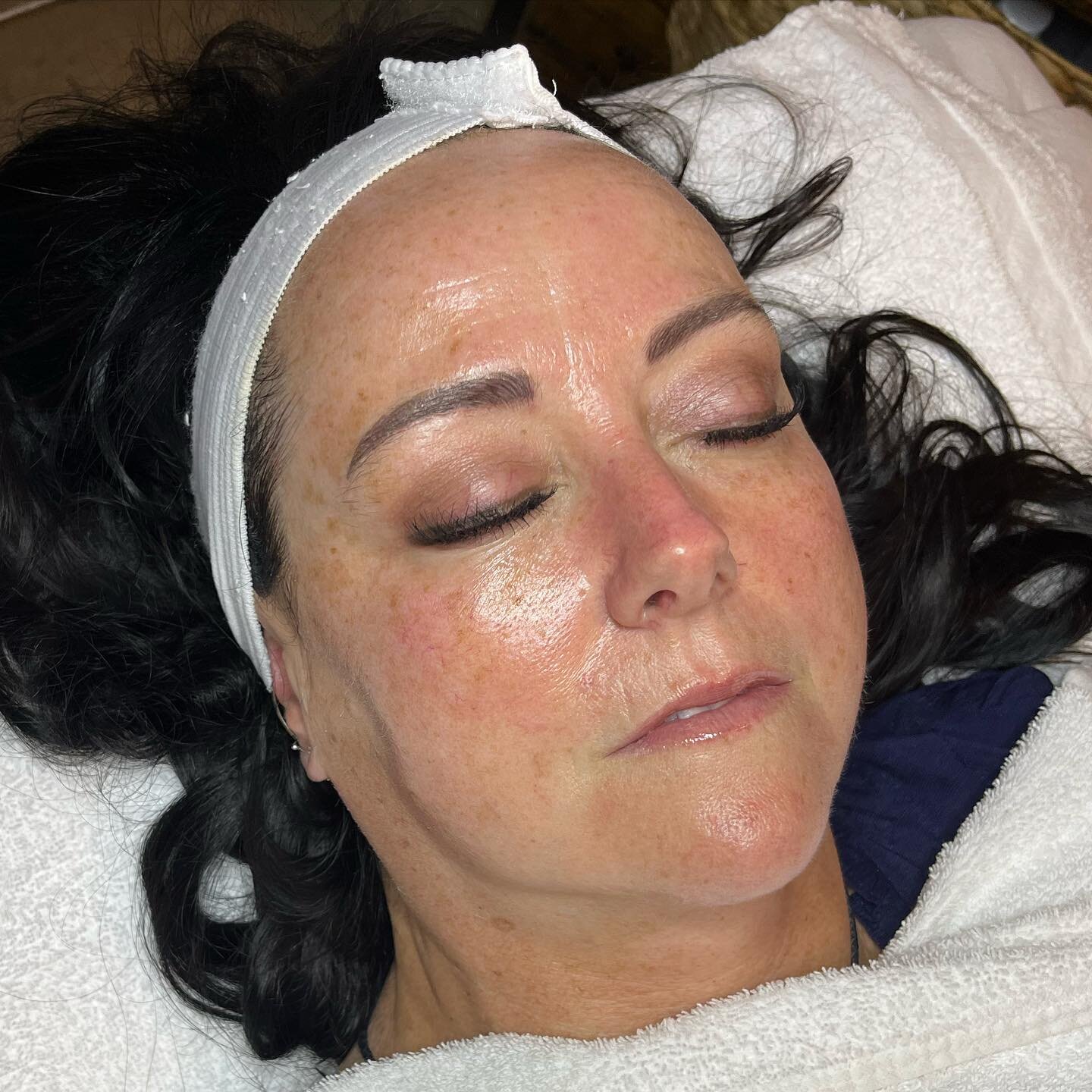 post nano infusion glow🤩 swipe to see the before:)