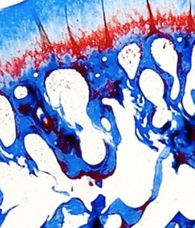 Musculoskeletal Infection Diagnostics