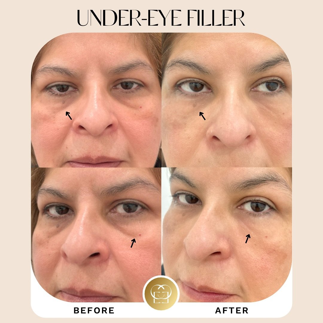 Refreshed, not overdone. Under-eye filler can brighten and smooth without changing your natural beauty. 💉✨

Work done by nurse Somaly ✅

💁🏻&zwj;♀️ Book your free consultation now!
Text: (949)-877-0256 /  Call: (714)-723-0770
https://www.eyecandybe
