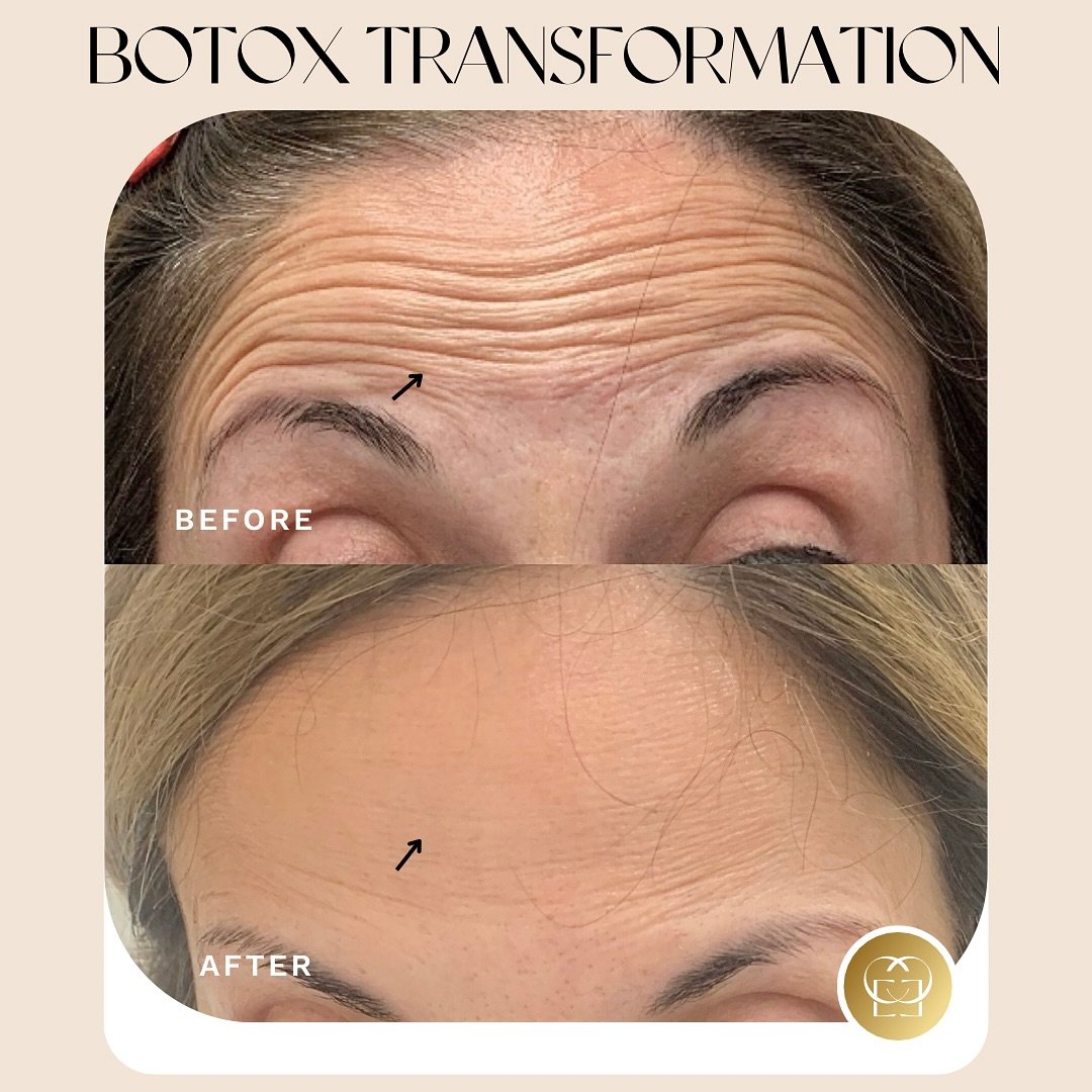 Smooth, fresh, and effortlessly flawless&mdash;just a little Botox goes a long way on the forehead. Bye-bye lines, hello glow.✨💖

✔️ Softens fine lines and deep wrinkles
✔️ Prevents new lines from forming
✔️ Quick treatment with zero downtime
✔️ Res