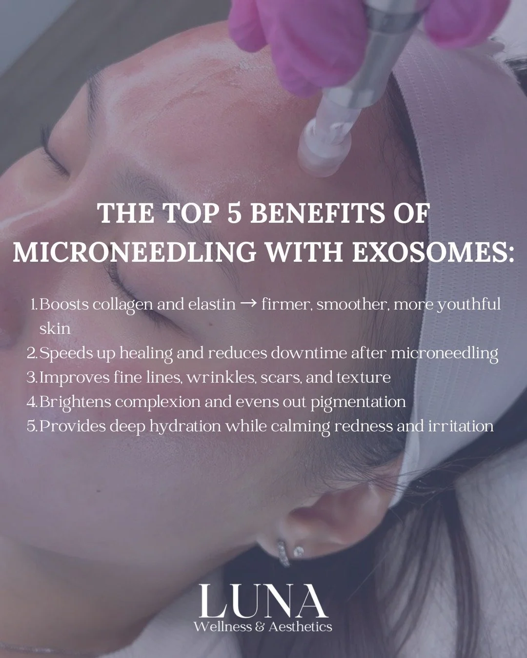 ✨ Top 5 Benefits of Microneedling with Exosomes ✨

This powerhouse combo takes skin rejuvenation to the next level&mdash;boosting your results and speeding up recovery. Think: faster healing, brighter skin, improved texture, and a serious collagen ki