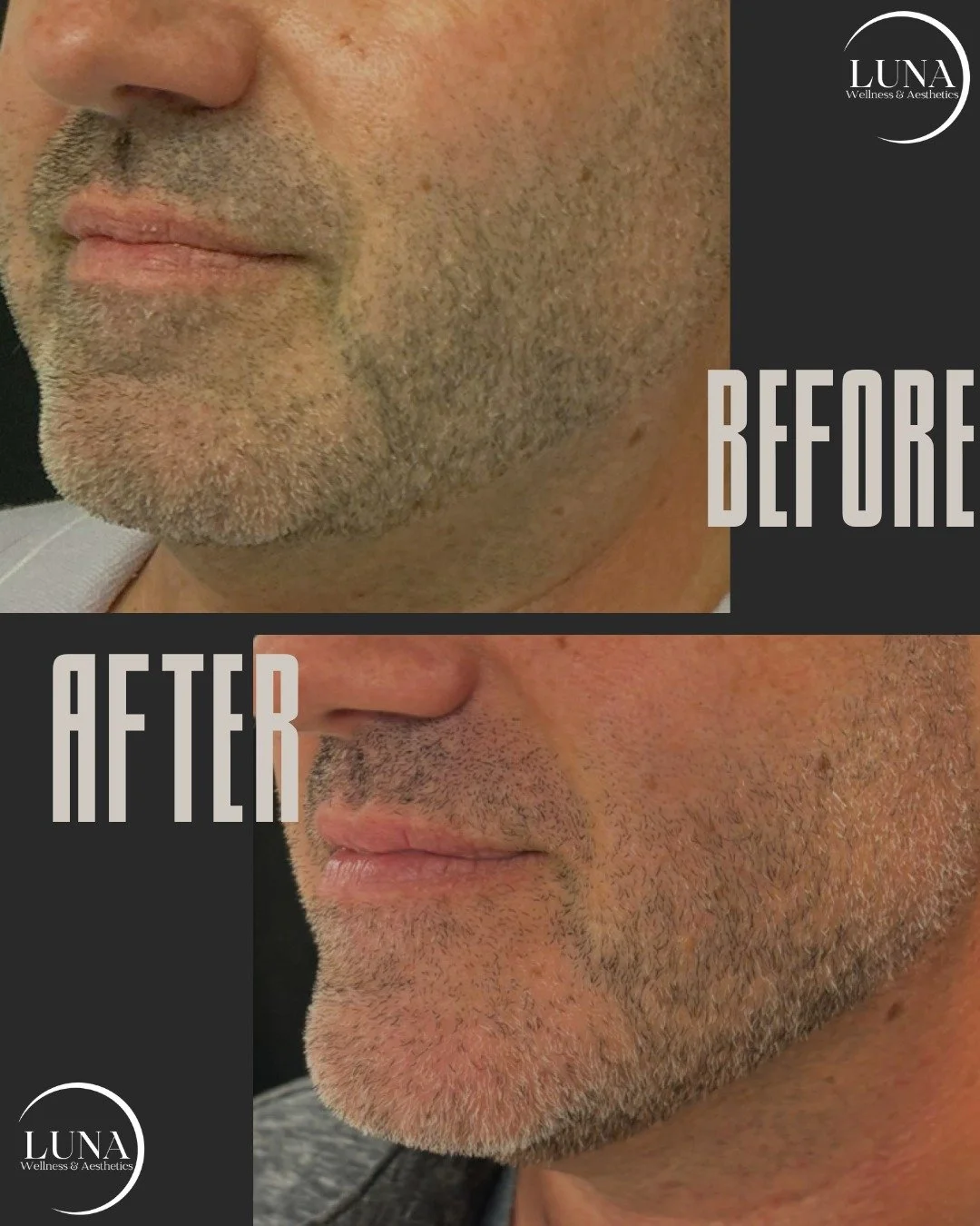 🔥 Jawline goals, unlocked. 🔥

These before-and-after results speak for themselves &mdash; a tighter, smoother, and more defined lower face. 💫

Our facial contouring treatment uses gentle radiofrequency heat to melt stubborn fat and tighten loose s