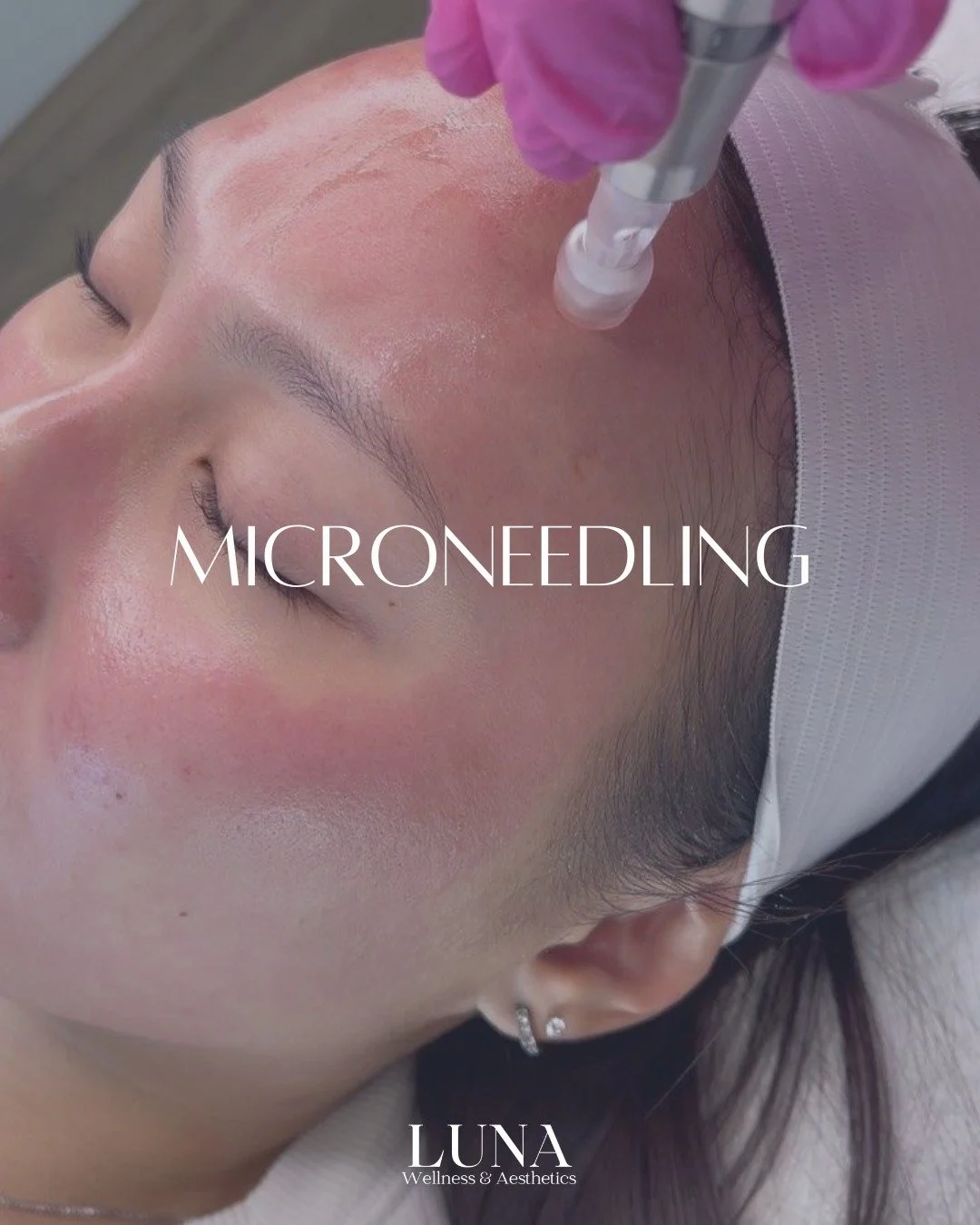 Fall and winter are prime time for microneedling 🍂✨ This collagen-boosting treatment smooths fine lines, minimizes pores, and refreshes dull skin &mdash; just in time for the holidays! Get ready to glow with smoother, firmer skin that looks as good 