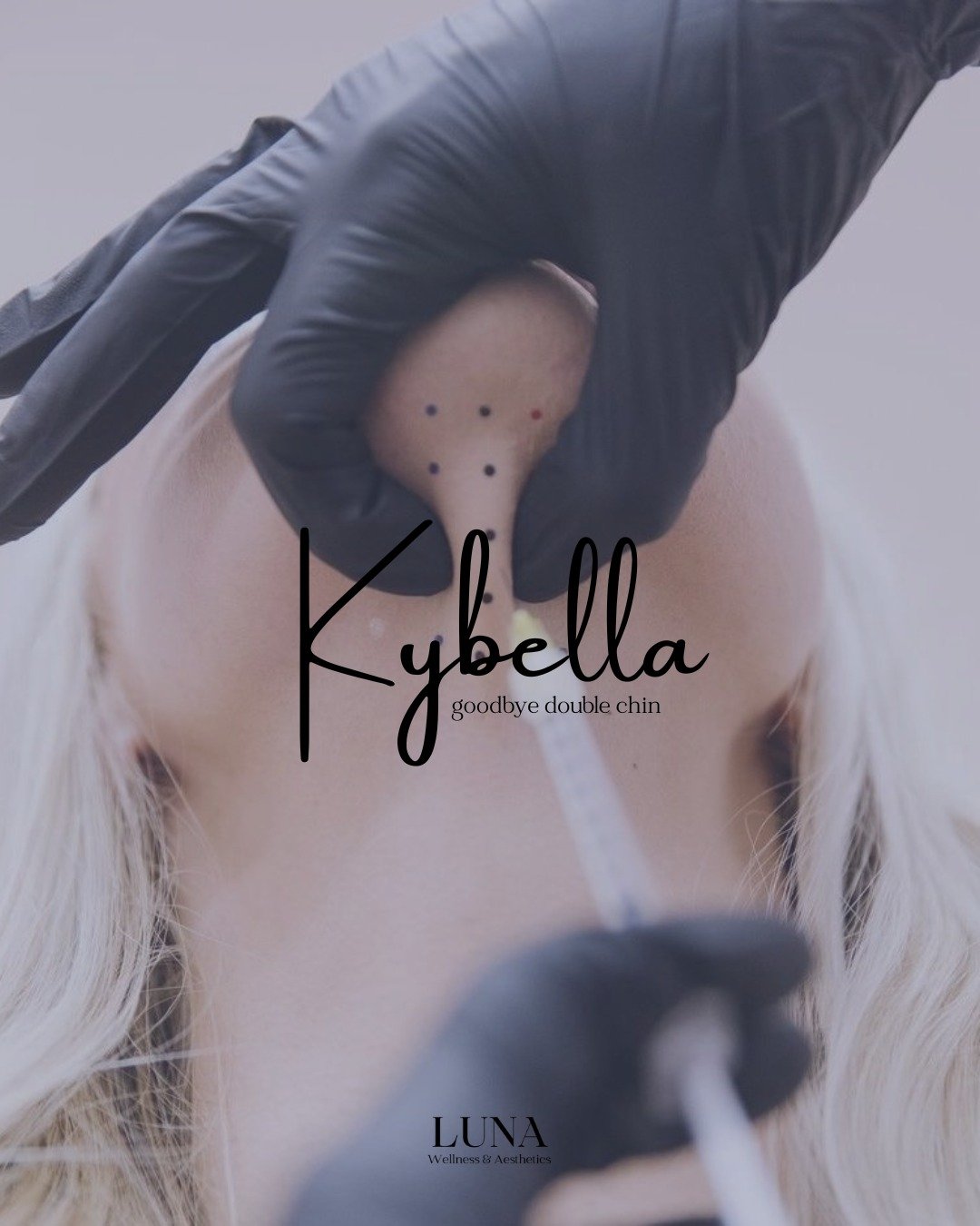 Kybella is a non-surgical injectable treatment designed to permanently dissolve stubborn pockets of fat &mdash; most commonly under the chin, along the jawline, or in small targeted areas that don&rsquo;t respond to diet or exercise.

It works by bre