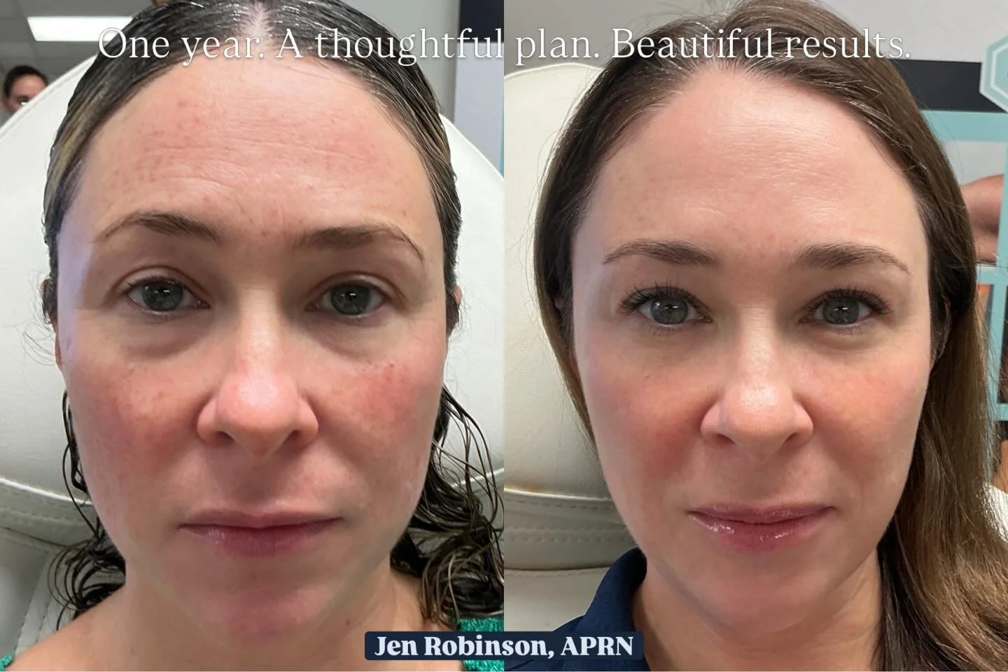 Great results don&rsquo;t come from one treatment &mdash; they come from a plan.

This beautiful patient trusted the process, and these results were achieved gradually over the course of one year with a customized treatment plan.

Instead of chasing 