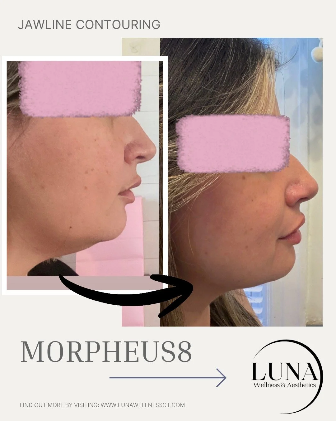 ✨ Snatched, sculpted, and naturally refined ✨

This is the power of **Morpheus8** for jawline contouring&mdash;tightening, lifting, and redefining without surgery 🤍

Over time, we lose collagen and elasticity&hellip; leading to softness along the ja