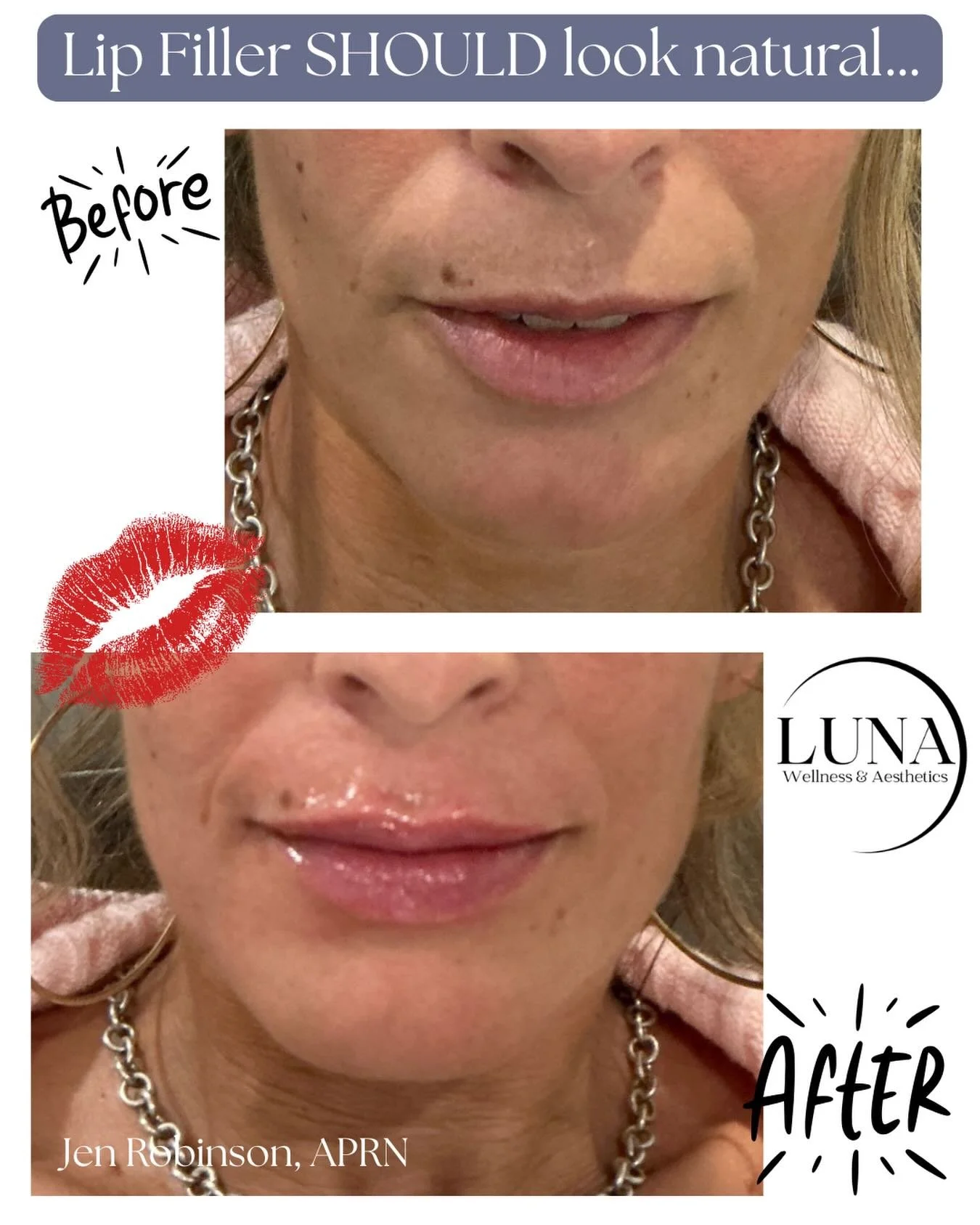 Natural. Balanced. Beautiful. ✨

This is what lip filler should look like &mdash; soft enhancement that complements your features without looking overdone. Subtle volume, improved shape, and hydrated, youthful lips while still looking completely like